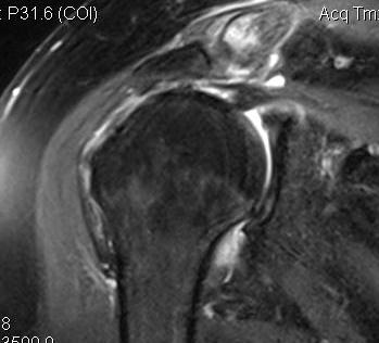 Massive RC Tear High Riding Humeral Head MRI